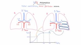 VQ mismatch [upl. by Godwin]