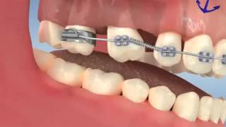 Diş kaybı sonrası tel tedavisi ve implant uygulaması [upl. by Eisdnyl]