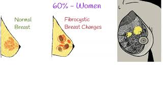 Fibrocystic breast Causes Symptoms and Treatment Fibrocystic Breast Disease [upl. by Axela]