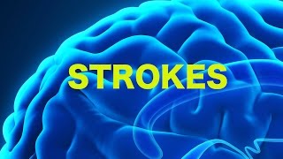 Strokes amp The Rule of 4s  USMLE [upl. by Artemla]