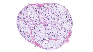 Mucinous carcinoma of skin  BEST EXAMPLE EVER AIP France 2021  Bonus case dermpath pathology [upl. by Ecirtnom]