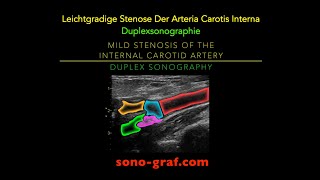 Duplexsonographie  Leichtgradige Stenose Der Arteria Carotis Interna [upl. by Vivian]