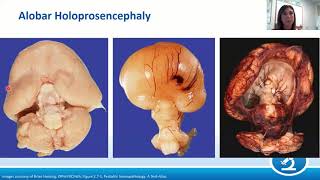 AANP Teaching Rounds  February 24 2021  Pediatric Neuropathology Malformations [upl. by Alaecim]