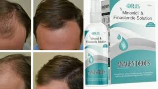 ANAGEN DROPS Solution Minoxidil amp Finasteride Solution [upl. by Ketty]