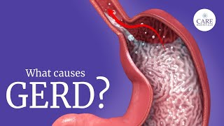 GERD  Gastroesophageal Reflux Disease GERD Causes Symptoms Treatment  Heart Burn  Acid Reflux [upl. by Slaby955]