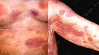 What is Mycosis Fungoides Symptoms Causes Treatment Diagnosis Cutaneous T Cell Lymphoma [upl. by Asfah]