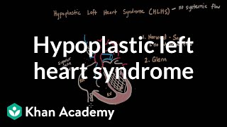 What is hypoplastic left heart syndrome HLHS [upl. by Yht]