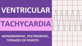 Ventricular Tachycardia Vtach ECG Interpretation Treatment Nursing NCLEX Review [upl. by Towland]