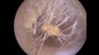 237  Dry Blocked Ear Wax Removal from Hairy Ear using Endoscopic Ear Microsuction [upl. by Golub24]