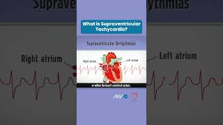 What is Supraventricular Tachycardia [upl. by Dadelos]