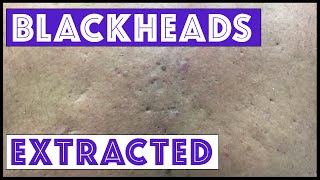 Were these blackheads amp cysts from Agent Orange exposure [upl. by Ruvolo564]