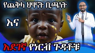 የጨቅላ ህፃናት ቢጫነት ካልታከመ የሚያመጣቸው የነርቭ ጉዳቶች  Neonatal Jaundice complications  DrFasil  ብሩህkids [upl. by Enelram]