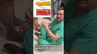 Complete Fat Removal During Lipedema Surgery Is it Good or Bad  Dr Boris Volshteyn [upl. by Mccormac24]