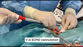 ECMO cannulation [upl. by Ia]