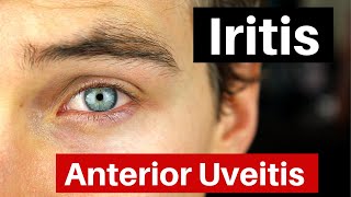 Iritis  What is Anterior Uveitis Doctor Explains [upl. by Ahsan]