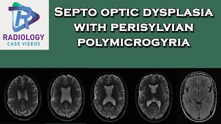 Septo optic dysplasia with perisylvian polymicrogyria [upl. by Berenice]