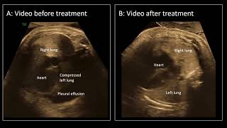 UOGJournal videoclip on the use of maternal propranolol treatment as therapy for fetal chylothorax [upl. by Sulrac131]