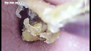 Ear Wax Removal 99 Itching And Sleepless Because Of A Lot Of Earwax  Ear Cleaning ASMR [upl. by Matilda619]