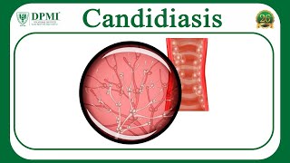 Candidiasis What is Candidiasis Candida Species– Morphology Pathogenesis of Candida Albicans [upl. by Tamis239]