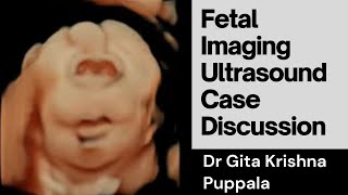 Fetal Imaging Spotter Cases with Dr Gita Krishna Puppala India [upl. by Byler]