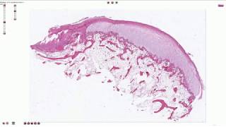 Ostechondroma  Histopathology [upl. by Melicent]