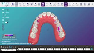 TrioClear™ iDesign 2 0 Tutoriel [upl. by Avehs]