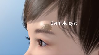 Dermoid Cyst Ablation [upl. by Zacherie]