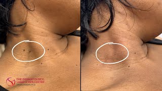 Skin Tag Removal  Dr Shalini Gupta [upl. by Kreegar152]