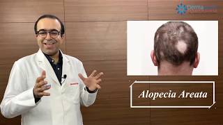 ALOPECIA AREATA Symptoms Causes amp Treatments  Dr Rohit Batra  Permanent Cure [upl. by Fari]