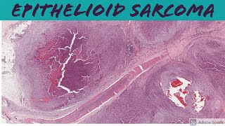 Epithelioid Sarcoma 5Minute Pathology Pearls [upl. by Ettegirb988]