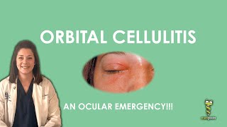 Orbital Cellulitis an ocular emergency [upl. by Auohs]