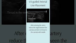 USguided Arterial Line Placement arteriallineciriticalcare USguidance [upl. by Itisahc]