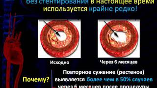 Коронарное стентирование преимущества и недостатки как можно улучшить результаты стентирования [upl. by Cleasta]