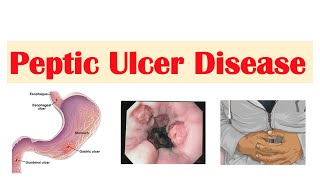 Peptic Ulcer Disease Gastric vs Duodenal Ulcers  Causes Symptoms Diagnosis Treatment [upl. by Lorry542]