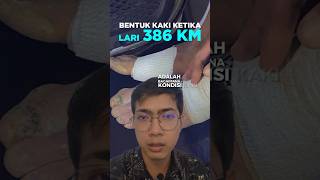 Kondisi kaki setelah lari 386 km selama 63 jam [upl. by Hadria10]