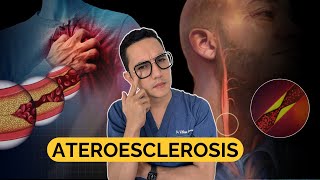 ATEROESCLEROSIS todo lo que debes saber  Dr William Guerrero [upl. by Babbie61]