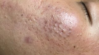 ACNE TREATMENT VU QUYNH MI  Blackheads On Boy Chin 2024FULL [upl. by Akenihs]