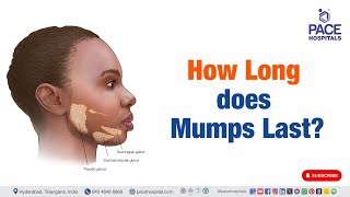 Mumps Last  How Long does Mumps Last  mumps shorts viralvideo [upl. by Eesac465]