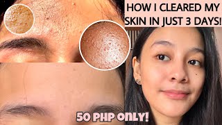 HOW TO GET RID OF TINY BUMPS ON FOREHEADFACE FAST  FUNGAL ACNE how i cleared my skin ENG SUB [upl. by Egdirdle366]