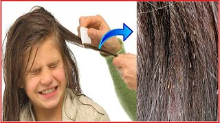 How to remove nits from Hair at Home without a Comb permanently [upl. by Nnyla141]