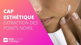 CAP Esthetique • LExtraction des point noirs [upl. by Sheldon]