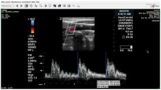 Carotid Duplex Moderate Stenosis  Case Study [upl. by Aeret492]