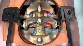 3D Medical Animation  Lumbar spine surgical procedure 2 level fusion of L4S1 [upl. by Enelaj]