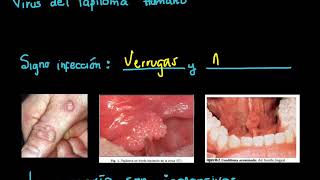 Virus y cavidad oral Virus del Papiloma Humano [upl. by Lledniuq471]