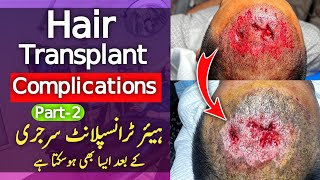 Hair Transplant Complications and Risks Part 2  Be Informed amp Prepared ⚠️ [upl. by Akinyt957]