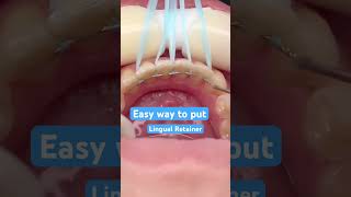 Easy way Lingual Retainer placement [upl. by Sisto]