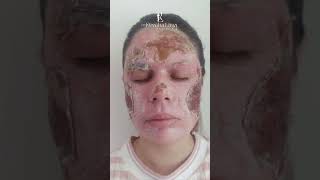 Peeling de Fenol para cicatrizes de acne [upl. by Arah]