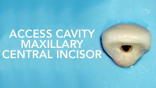 Pre Clinical Endodontic  Access Cavity of Maxillary Central Incisor [upl. by Llewen]