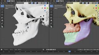 Virtual planning for orthognathic surgery [upl. by Adnalro]