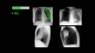 Lobar Atelectasis on Frontal and Lateral Chest XRays UndergroundMed [upl. by Zerdna]